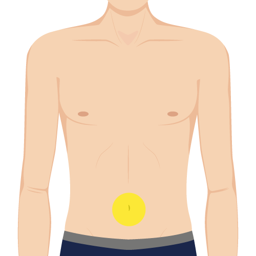 ヘソ周り照射範囲