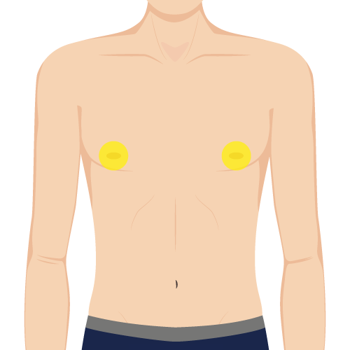 乳輪周り照射範囲